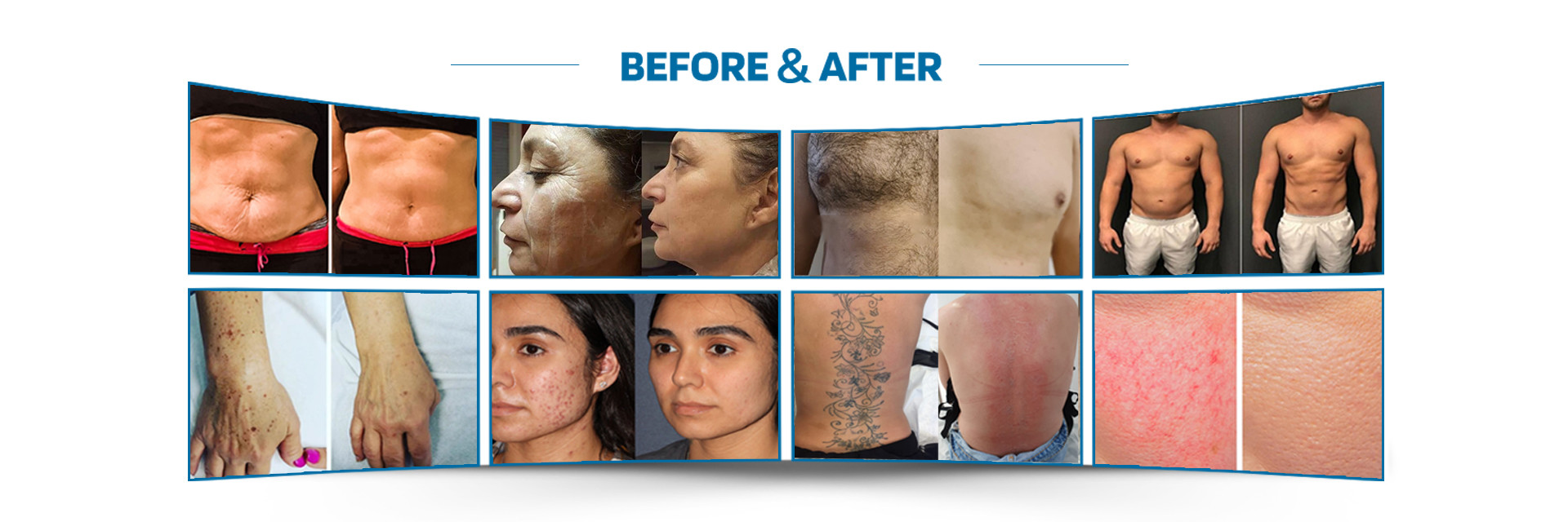 jakość laserowa maszyna do usuwania włosów fabryka