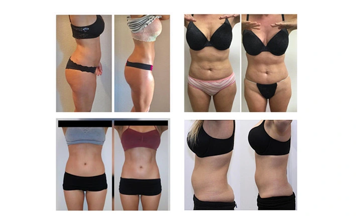 Zaawansowana 6D lipolaser lipolysis 209mw Super 6d Lipo Laser Liposuction Machine z 635nm 650nm 780nm 810nm 940nm 980nm 6