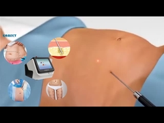 Laser Lipo Sprzęt 30W 60W 980nm Diody Lipo Laser Maszyna do odchudzania